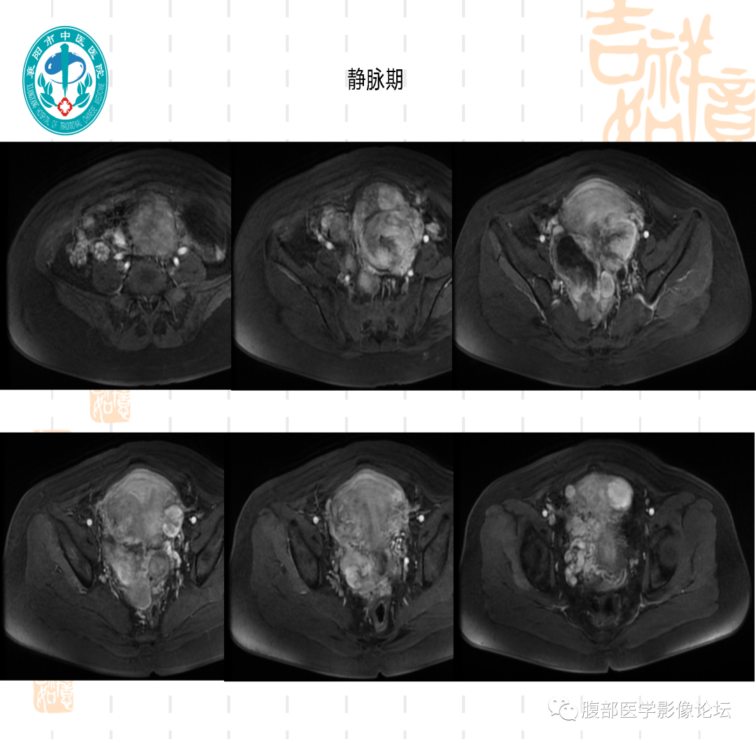 影像PPT - 【病例】子宫内膜间质肉瘤1例MR-11 影像PPT - 【病例】子宫内膜间质肉瘤1例MR-11