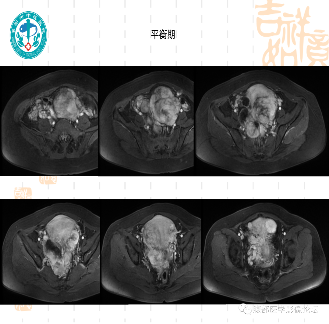 影像PPT - 【病例】子宫内膜间质肉瘤1例MR-12 影像PPT - 【病例】子宫内膜间质肉瘤1例MR-12