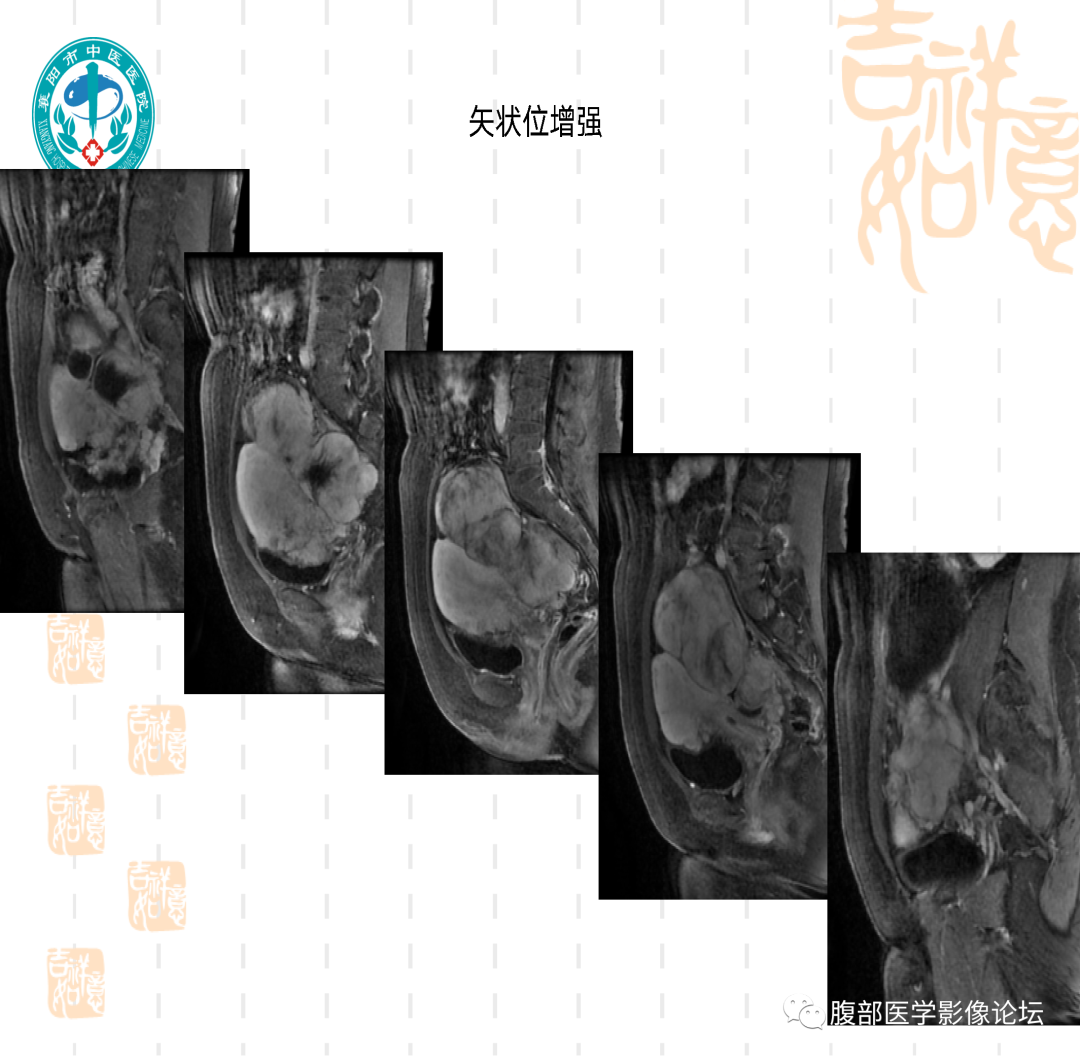 影像PPT - 【病例】子宫内膜间质肉瘤1例MR-13 影像PPT - 【病例】子宫内膜间质肉瘤1例MR-13