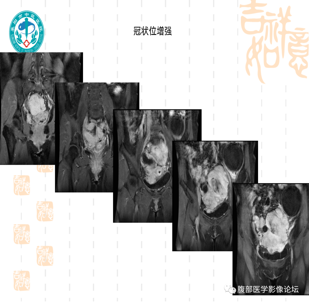 影像PPT - 【病例】子宫内膜间质肉瘤1例MR-14 影像PPT - 【病例】子宫内膜间质肉瘤1例MR-14