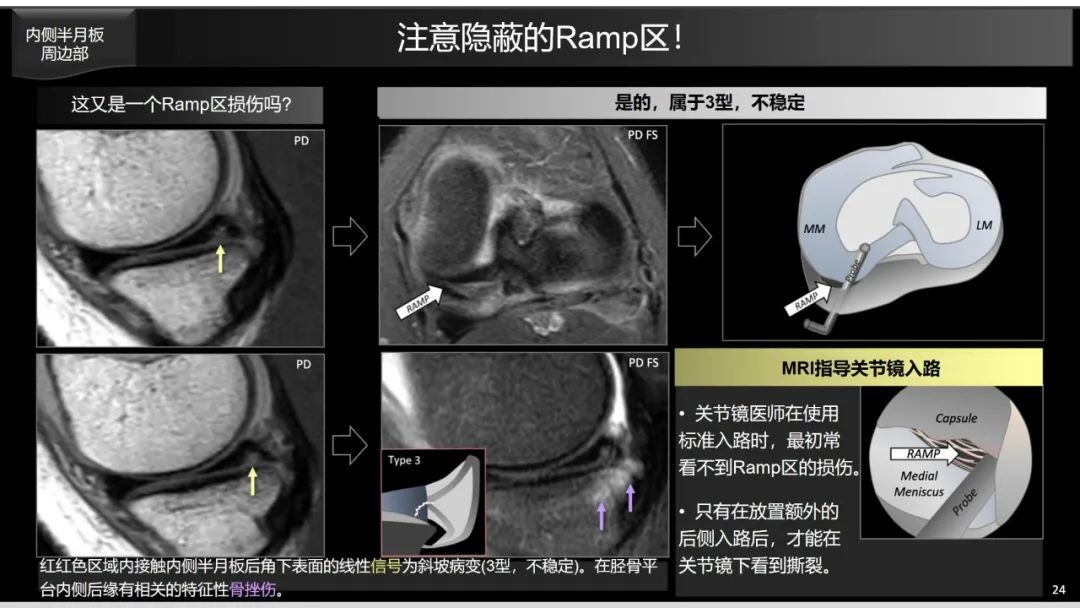 影像PPT - 【PPT】半月板根部,Ramp区,修复,及其后遗症-2 影像PPT - 【PPT】半月板根部,Ramp区,修复,及其后遗症-2