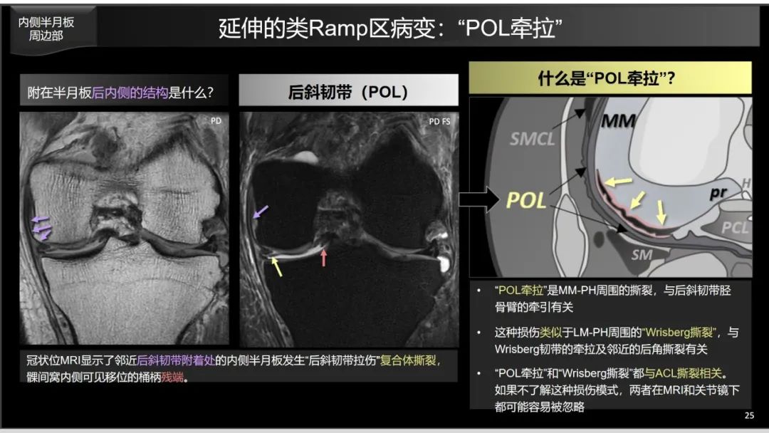 影像PPT - 【PPT】半月板根部,Ramp区,修复,及其后遗症-4 影像PPT - 【PPT】半月板根部,Ramp区,修复,及其后遗症-4