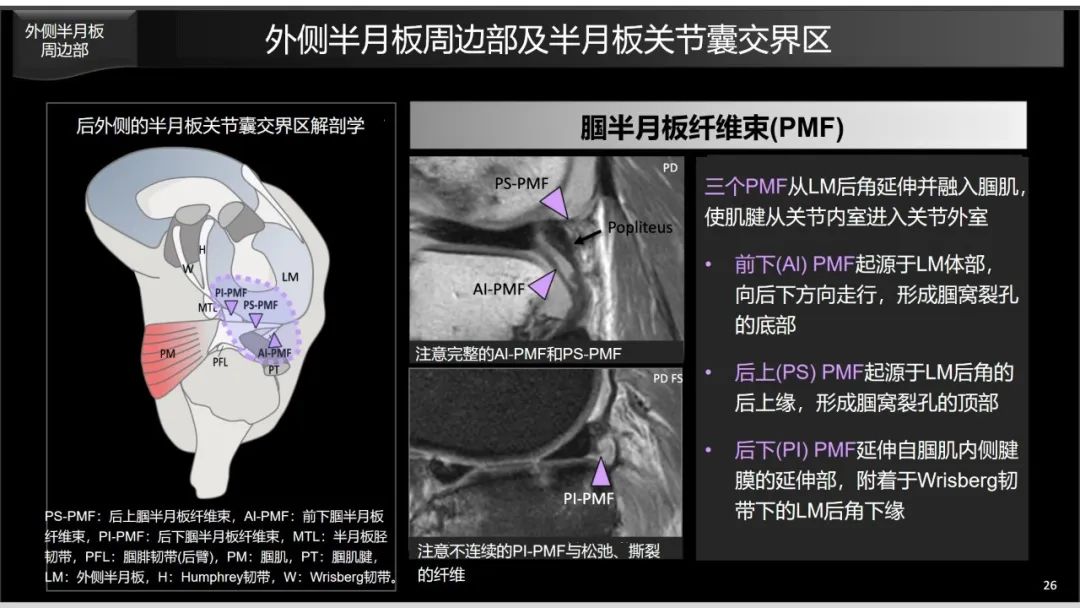 影像PPT - 【PPT】半月板根部,Ramp区,修复,及其后遗症-6 影像PPT - 【PPT】半月板根部,Ramp区,修复,及其后遗症-6