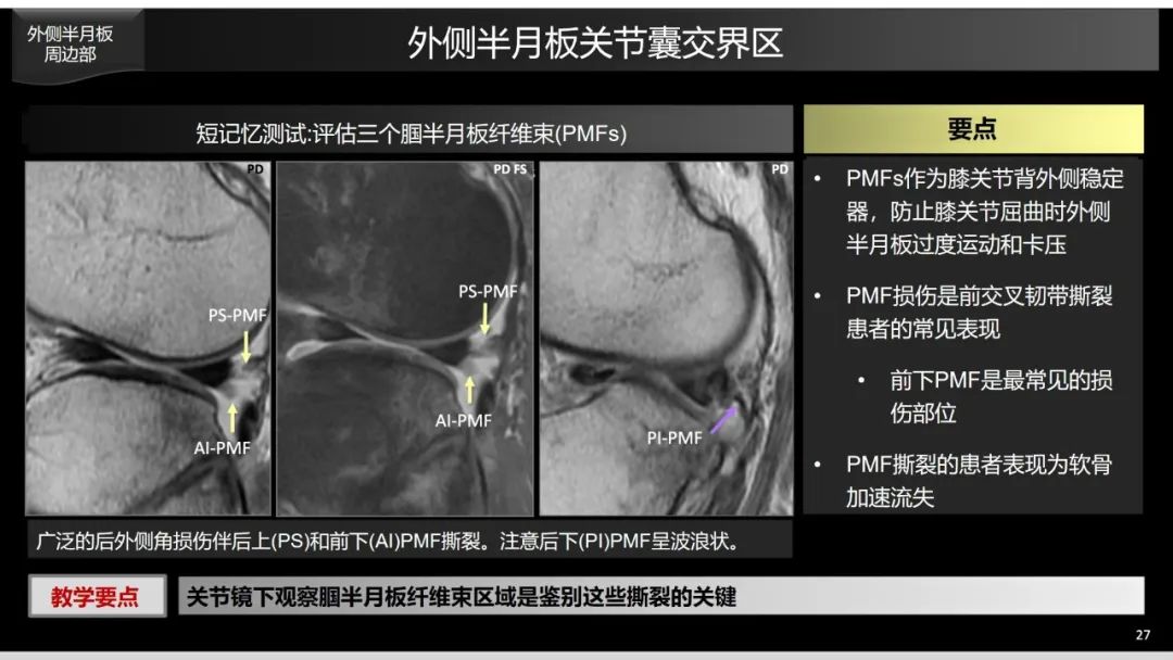 影像PPT - 【PPT】半月板根部,Ramp区,修复,及其后遗症-8 影像PPT - 【PPT】半月板根部,Ramp区,修复,及其后遗症-8