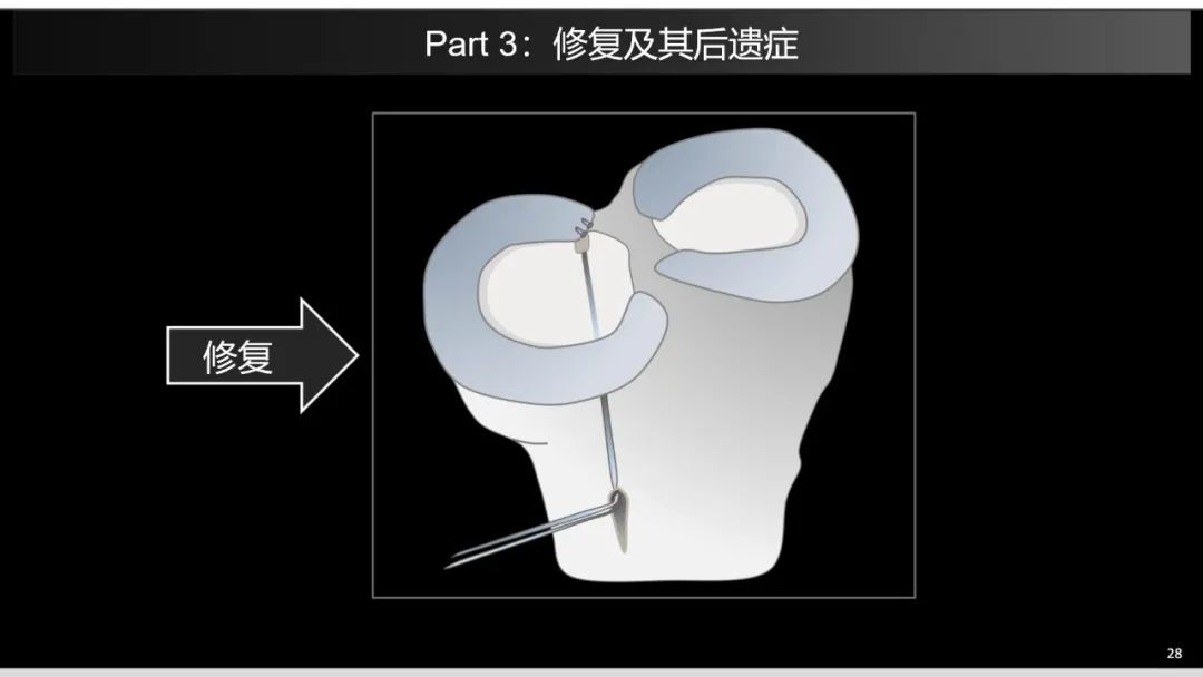 影像PPT - 【PPT】半月板根部,Ramp区,修复,及其后遗症-10 影像PPT - 【PPT】半月板根部,Ramp区,修复,及其后遗症-10