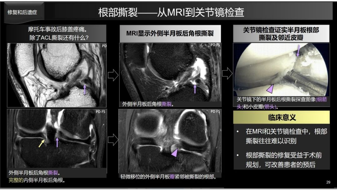 影像PPT - 【PPT】半月板根部,Ramp区,修复,及其后遗症-12 影像PPT - 【PPT】半月板根部,Ramp区,修复,及其后遗症-12