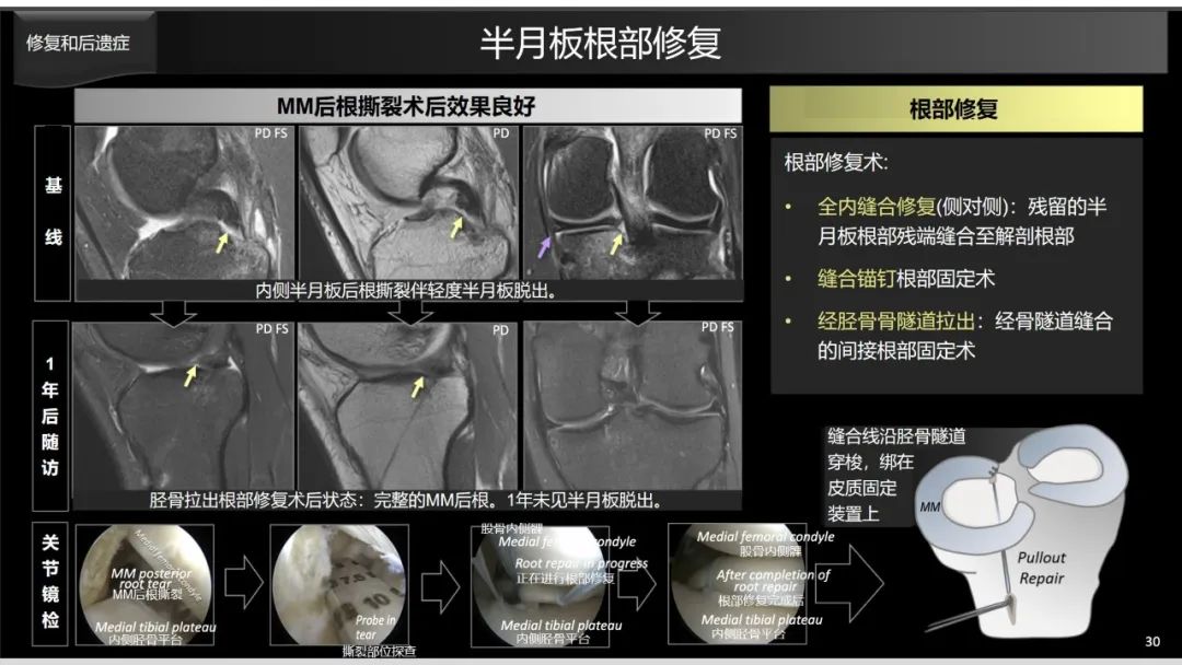 影像PPT - 【PPT】半月板根部,Ramp区,修复,及其后遗症-14 影像PPT - 【PPT】半月板根部,Ramp区,修复,及其后遗症-14