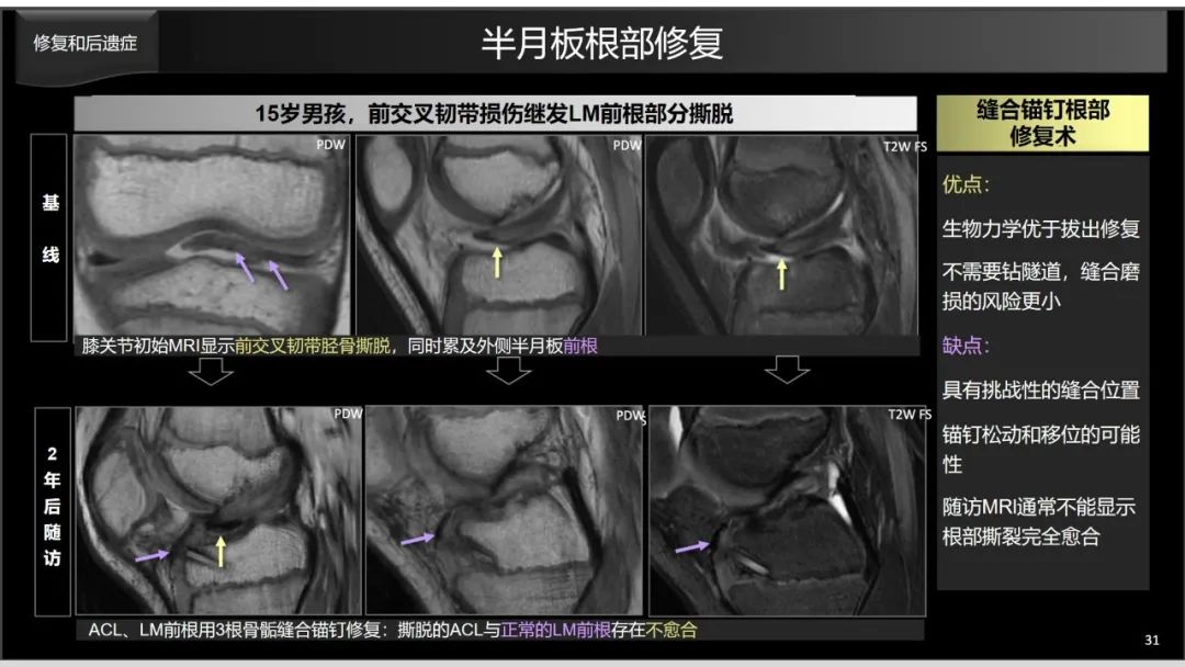 影像PPT - 【PPT】半月板根部,Ramp区,修复,及其后遗症-16 影像PPT - 【PPT】半月板根部,Ramp区,修复,及其后遗症-16