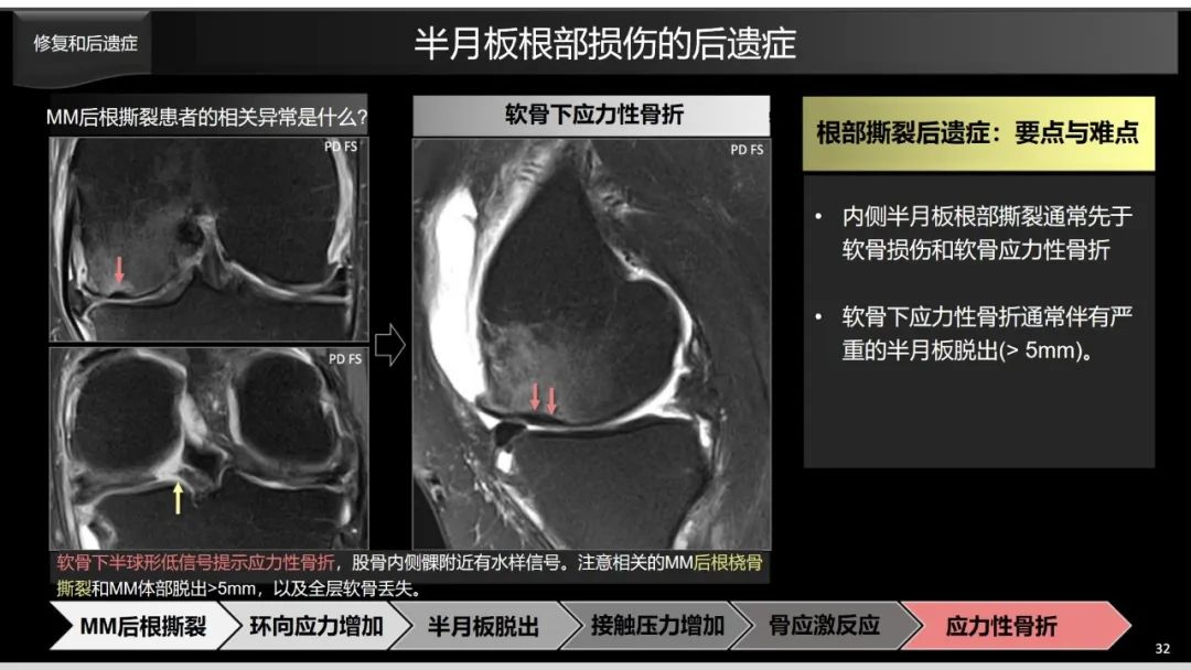 影像PPT - 【PPT】半月板根部,Ramp区,修复,及其后遗症-18 影像PPT - 【PPT】半月板根部,Ramp区,修复,及其后遗症-18