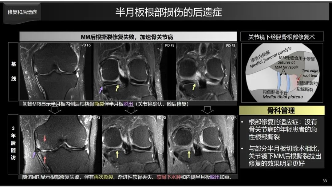影像PPT - 【PPT】半月板根部,Ramp区,修复,及其后遗症-20 影像PPT - 【PPT】半月板根部,Ramp区,修复,及其后遗症-20