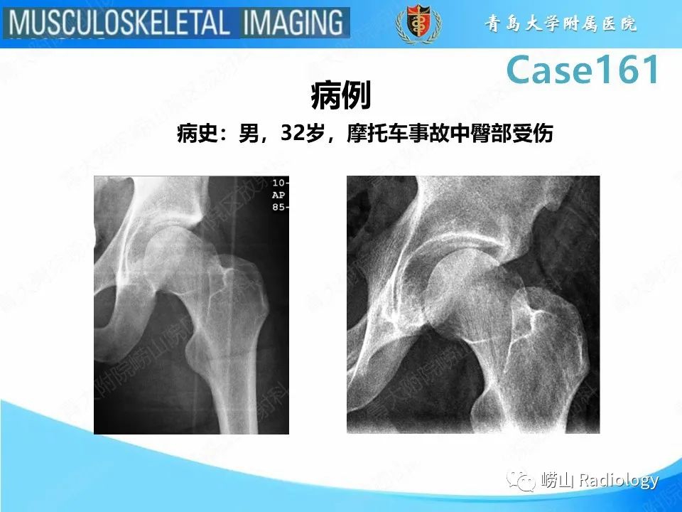 影像PPT - 【PPT】股骨头骨折-2