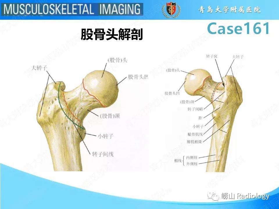 影像PPT - 【PPT】股骨头骨折-14