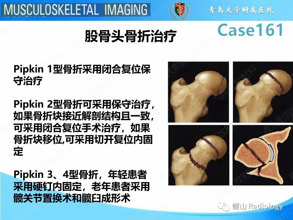 影像PPT - 【PPT】股骨头骨折-16