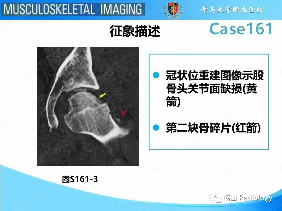 影像PPT - 【PPT】股骨头骨折-19