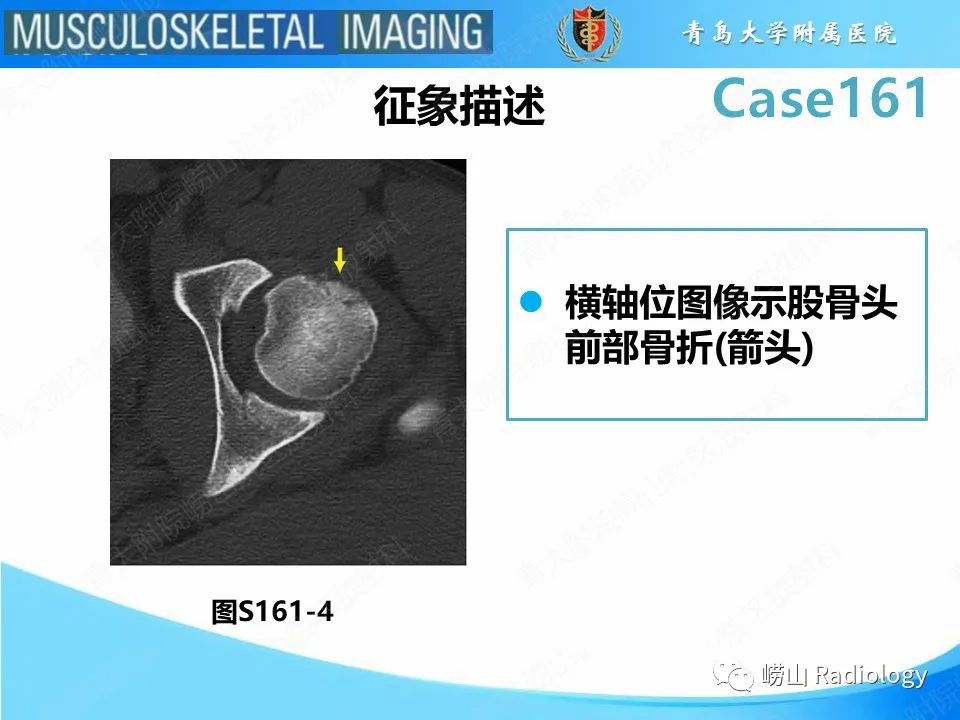 影像PPT - 【PPT】股骨头骨折-20