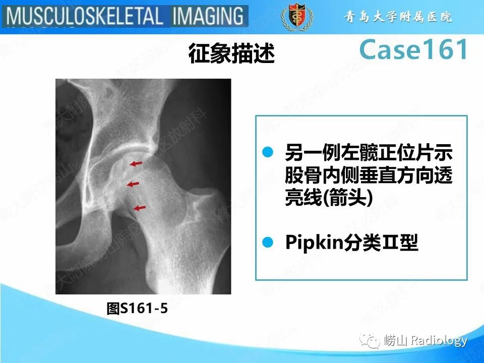 影像PPT - 【PPT】股骨头骨折-21