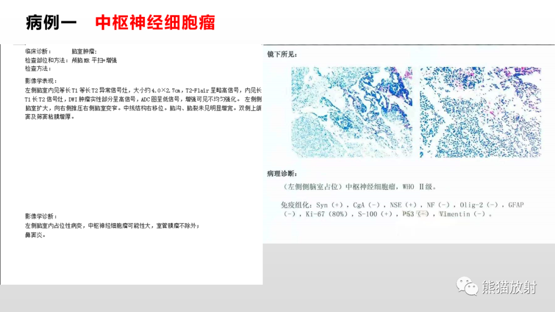 影像PPT - 【PPT】常见侧脑室占位的影像诊断-24