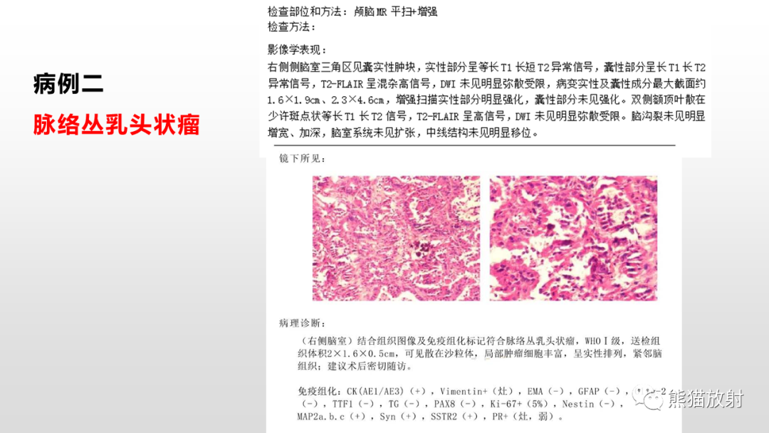 影像PPT - 【PPT】常见侧脑室占位的影像诊断-25