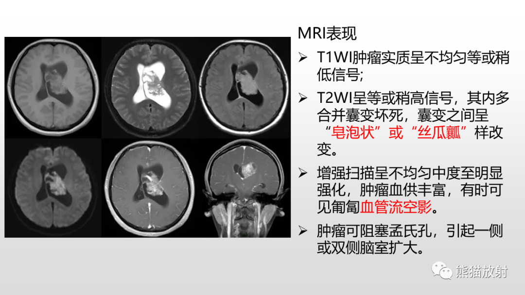 影像PPT - 【PPT】常见侧脑室占位的影像诊断-32