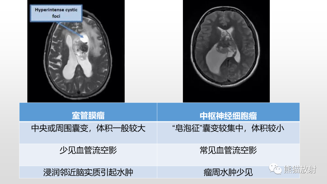 影像PPT - 【PPT】常见侧脑室占位的影像诊断-33