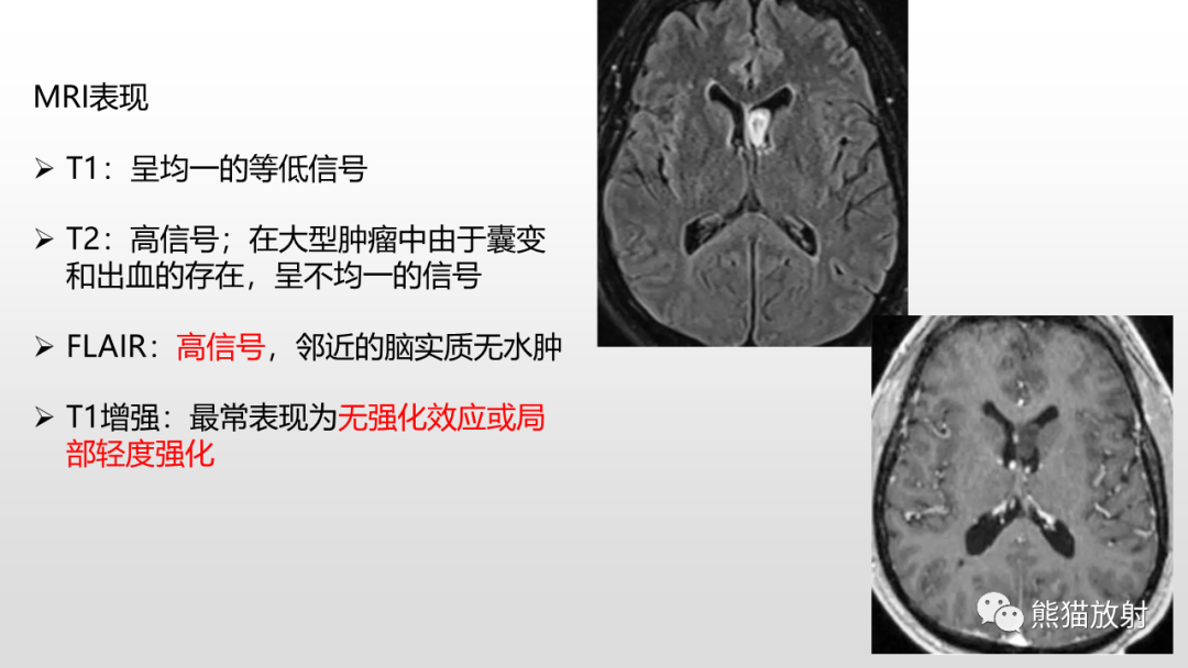 影像PPT - 【PPT】常见侧脑室占位的影像诊断-35