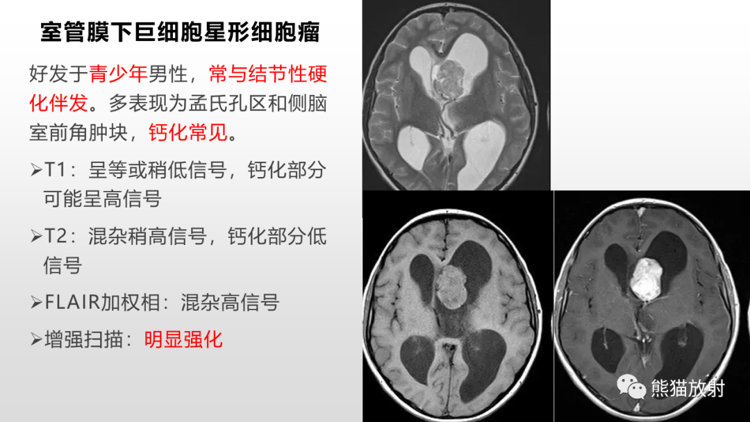 影像PPT - 【PPT】常见侧脑室占位的影像诊断-36