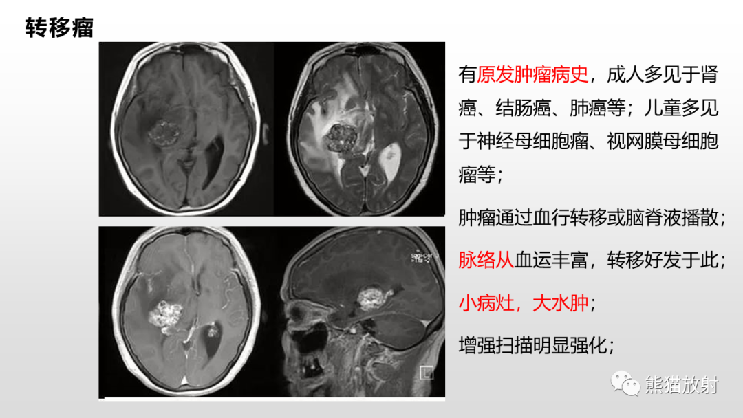 影像PPT - 【PPT】常见侧脑室占位的影像诊断-39