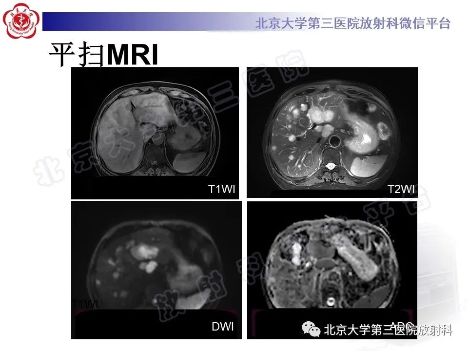 影像PPT - 【PPT】原发性肝脏神经内分泌肿瘤-3