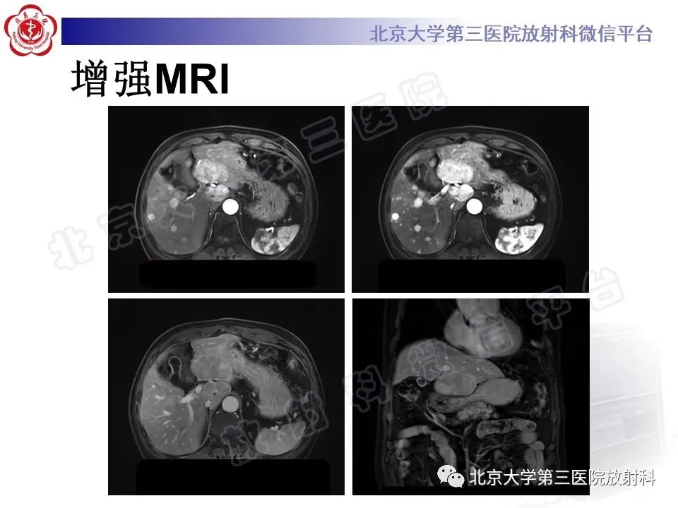 影像PPT - 【PPT】原发性肝脏神经内分泌肿瘤-4