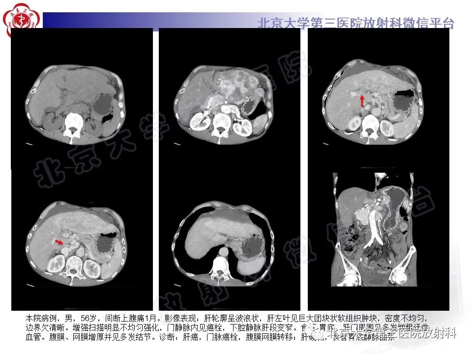 影像PPT - 【PPT】原发性肝脏神经内分泌肿瘤-14