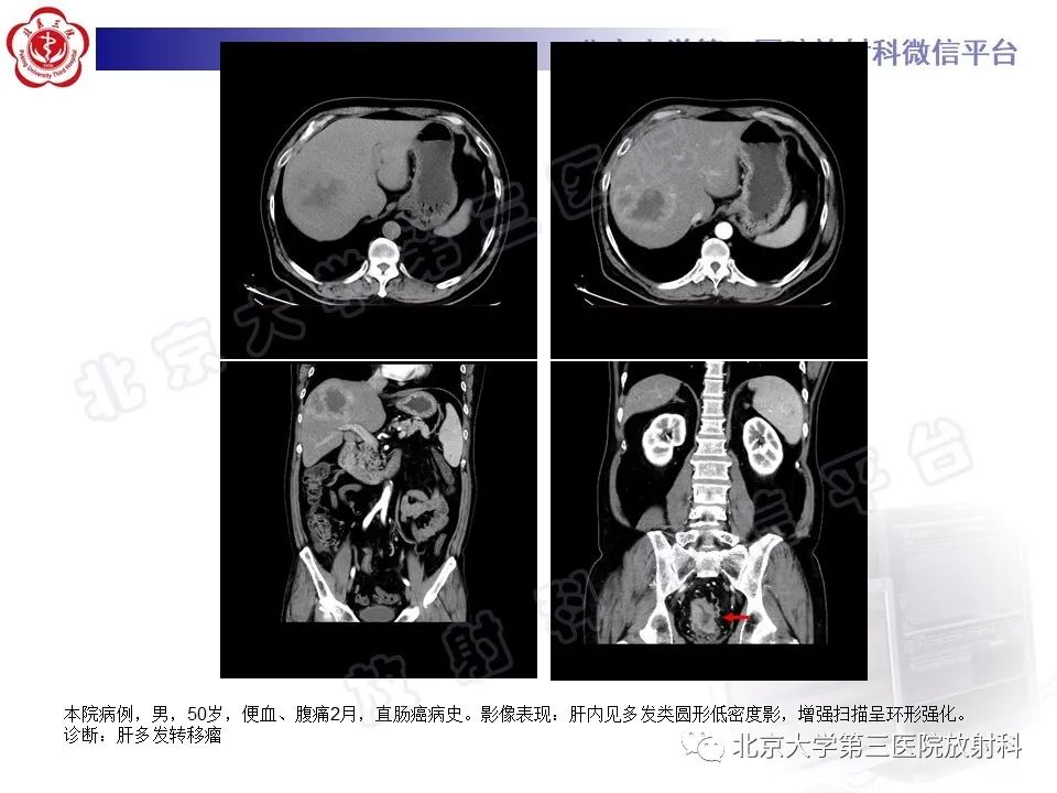 影像PPT - 【PPT】原发性肝脏神经内分泌肿瘤-16