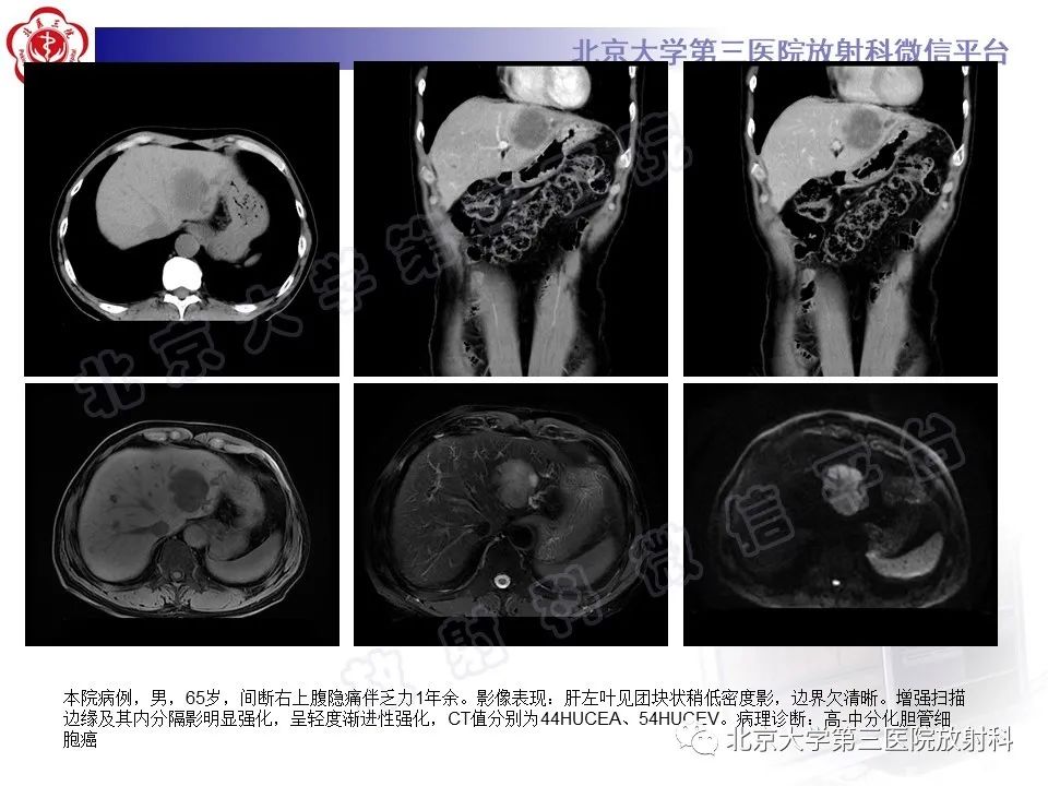 影像PPT - 【PPT】原发性肝脏神经内分泌肿瘤-18