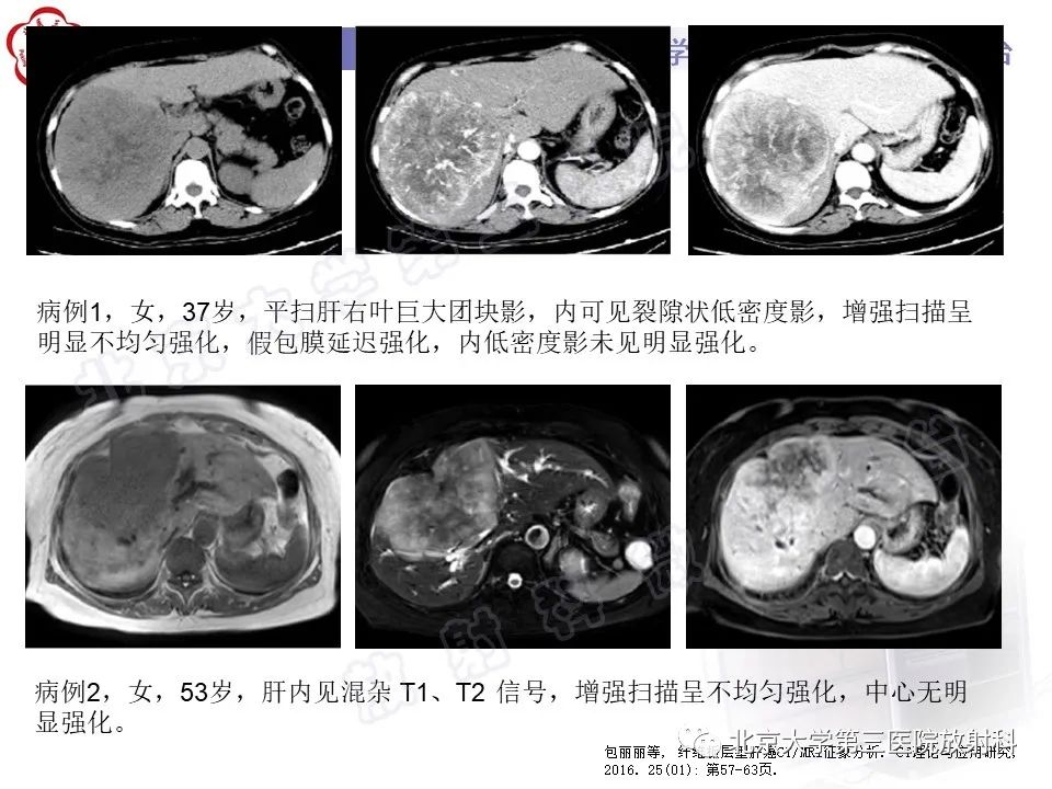 影像PPT - 【PPT】原发性肝脏神经内分泌肿瘤-20