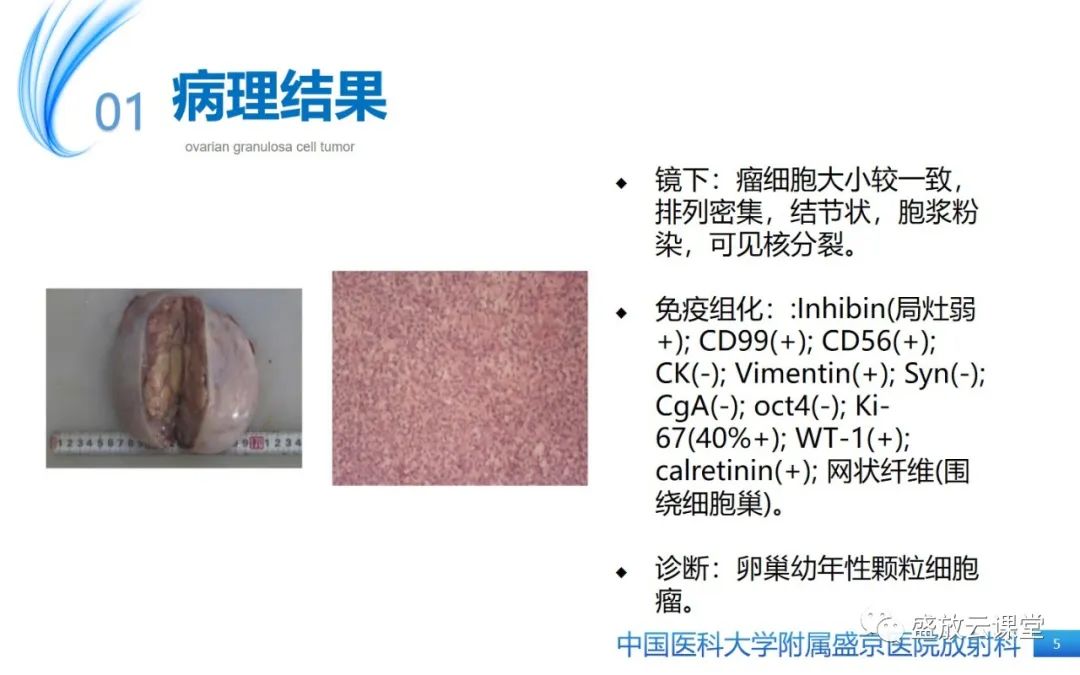 影像PPT - 【PPT】卵巢颗粒细胞瘤-5