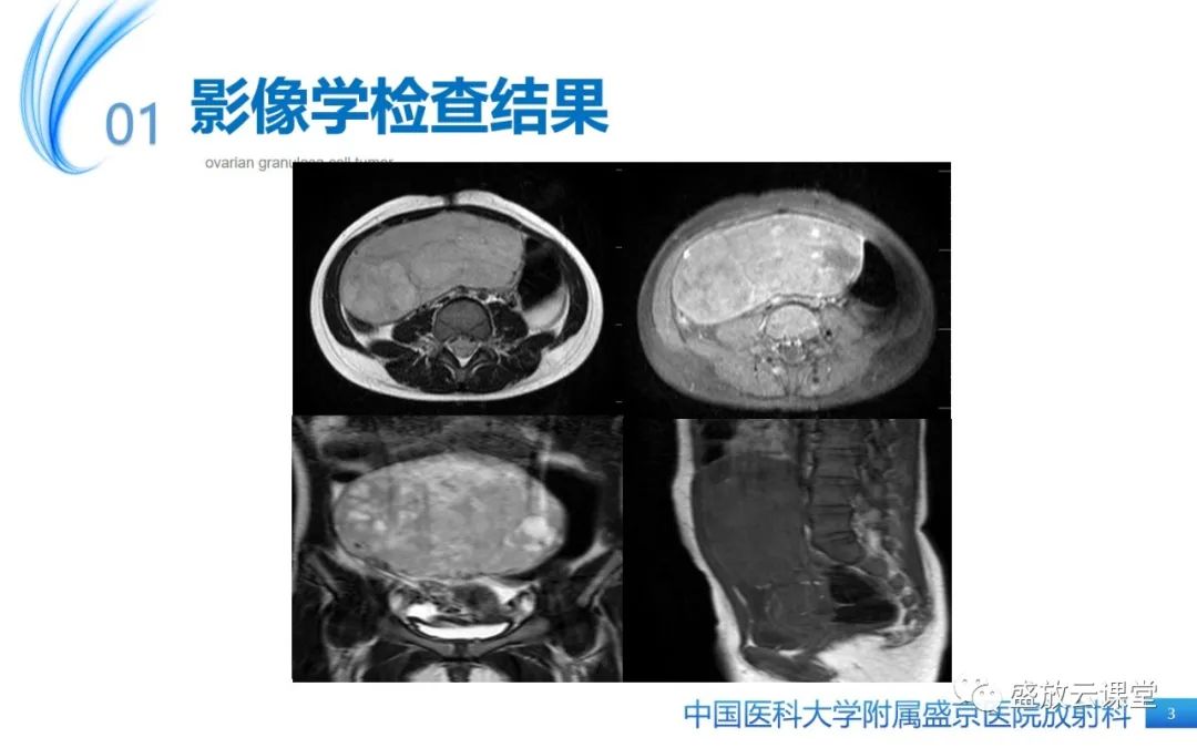 影像PPT - 【PPT】卵巢颗粒细胞瘤-3