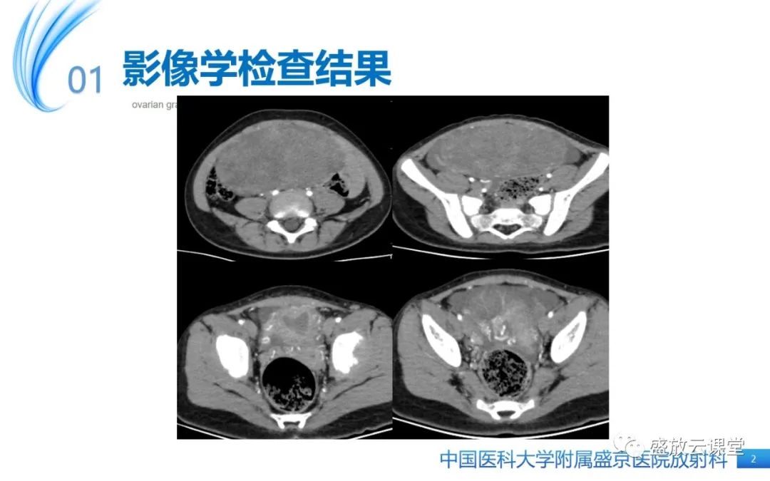 影像PPT - 【PPT】卵巢颗粒细胞瘤-2