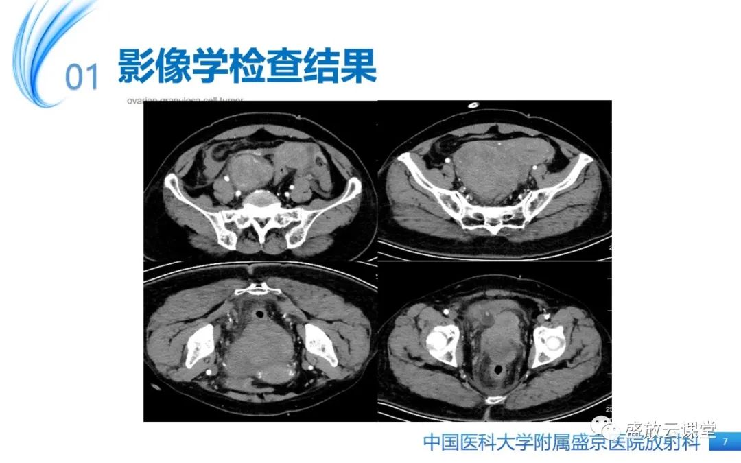 影像PPT - 【PPT】卵巢颗粒细胞瘤-7