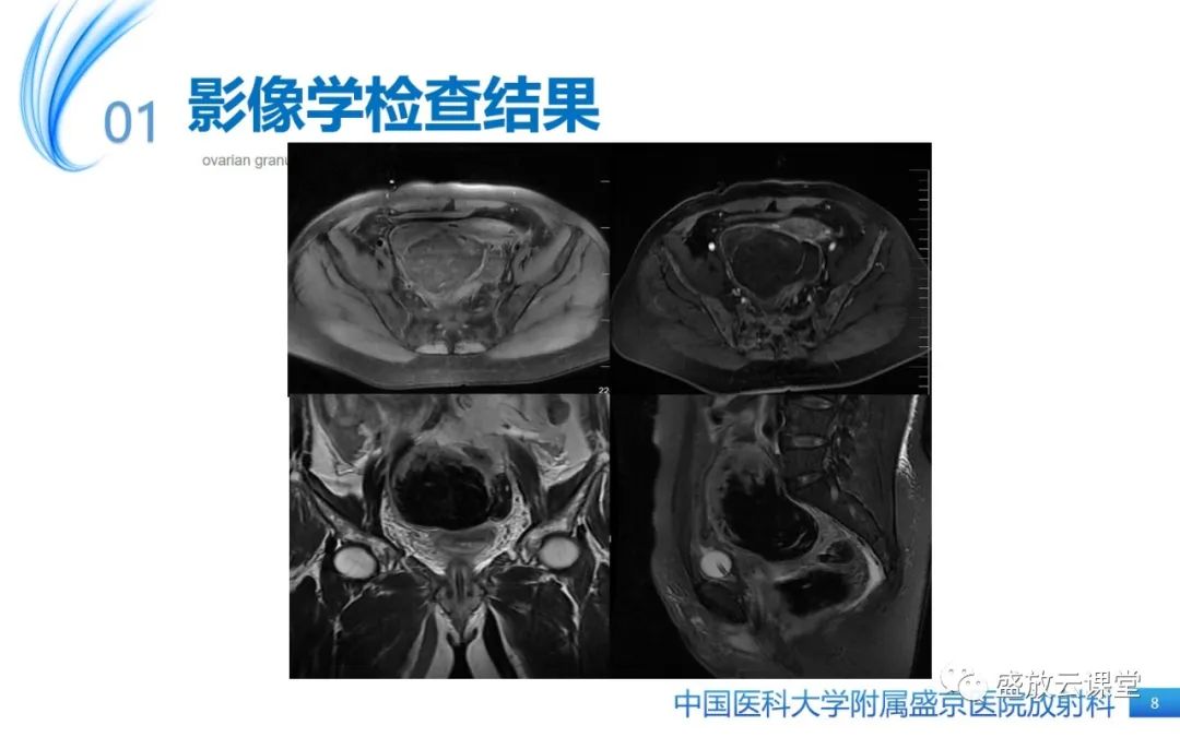 影像PPT - 【PPT】卵巢颗粒细胞瘤-8
