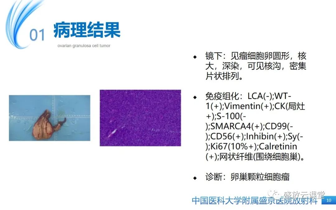 影像PPT - 【PPT】卵巢颗粒细胞瘤-9