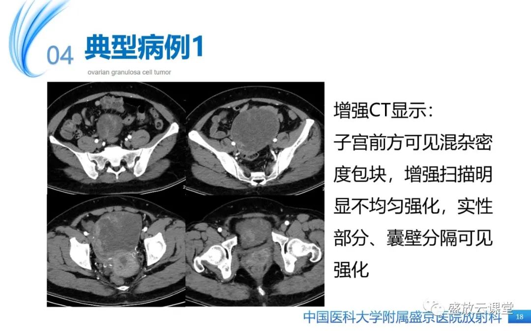 影像PPT - 【PPT】卵巢颗粒细胞瘤-17