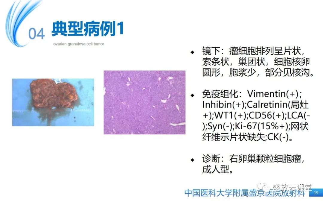 影像PPT - 【PPT】卵巢颗粒细胞瘤-18