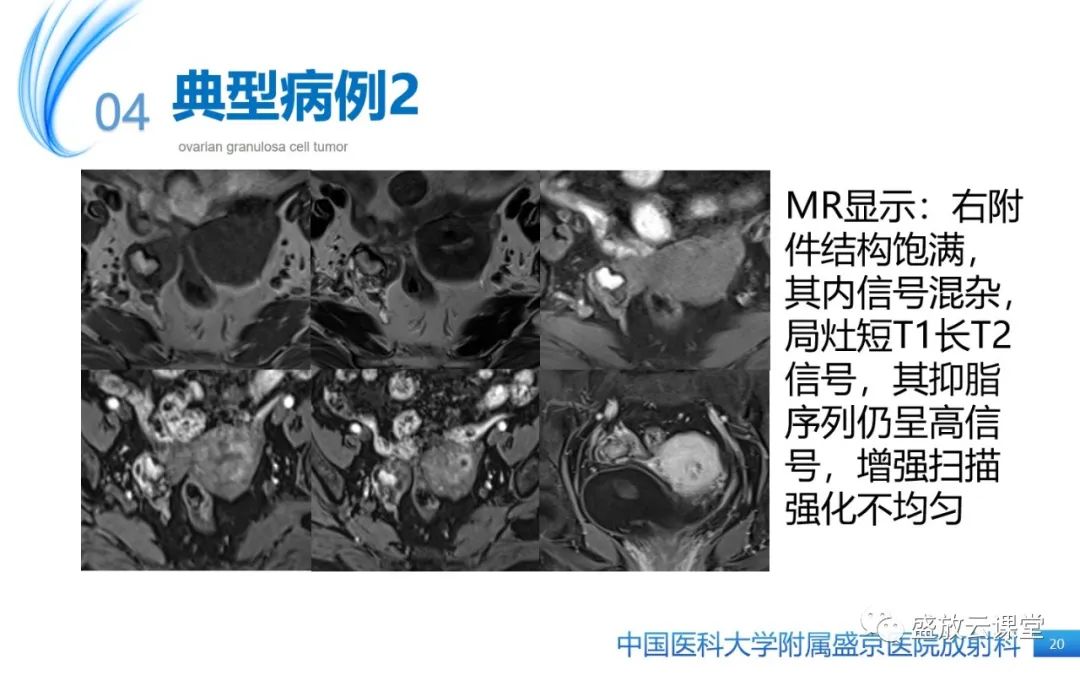 影像PPT - 【PPT】卵巢颗粒细胞瘤-19