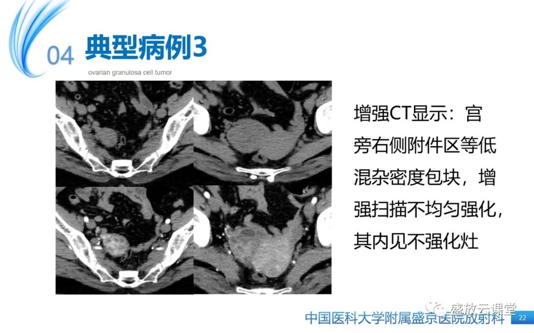 影像PPT - 【PPT】卵巢颗粒细胞瘤-21