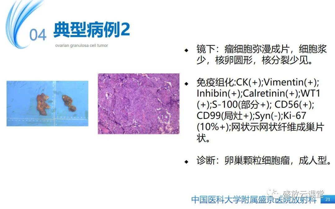影像PPT - 【PPT】卵巢颗粒细胞瘤-20