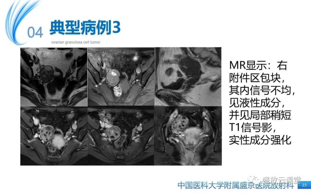 影像PPT - 【PPT】卵巢颗粒细胞瘤-22