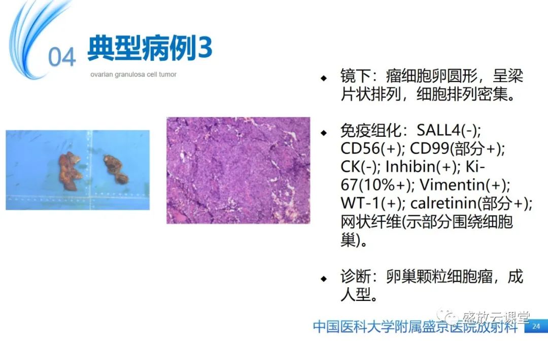 影像PPT - 【PPT】卵巢颗粒细胞瘤-23