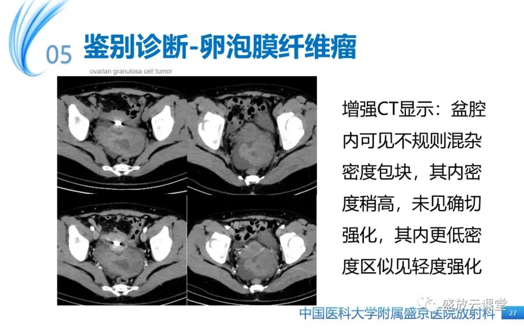 影像PPT - 【PPT】卵巢颗粒细胞瘤-26