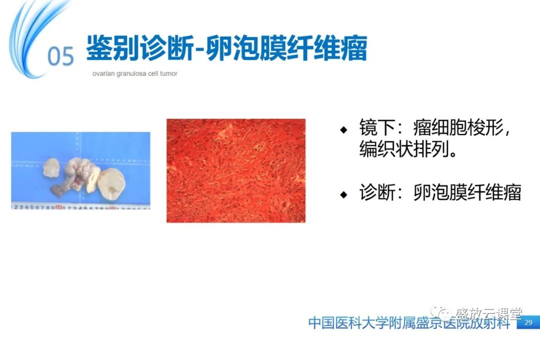 影像PPT - 【PPT】卵巢颗粒细胞瘤-28