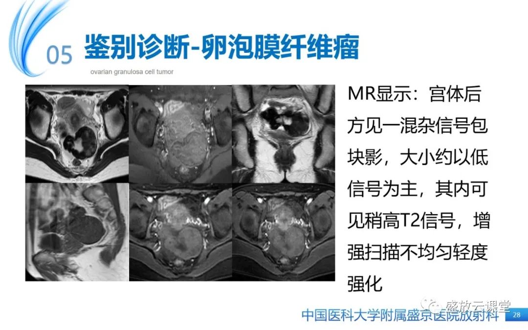 影像PPT - 【PPT】卵巢颗粒细胞瘤-27