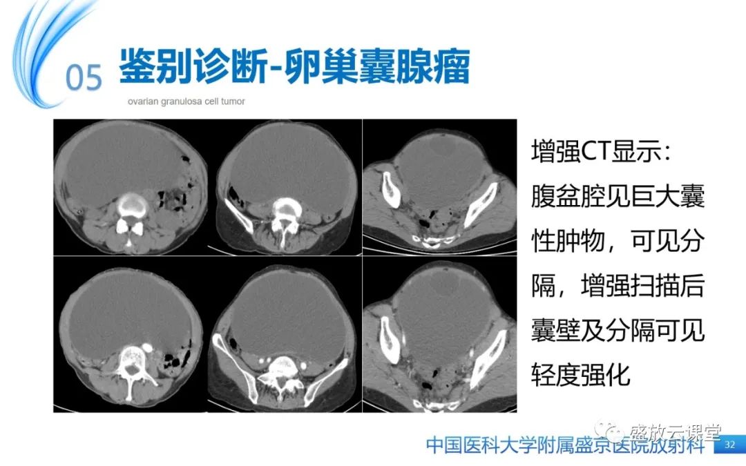 影像PPT - 【PPT】卵巢颗粒细胞瘤-31